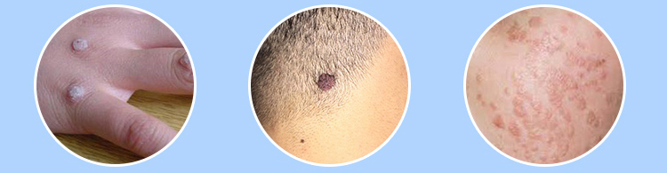 bút xóa mụn cóc, u cục